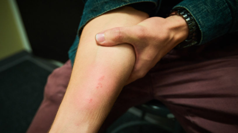 Person holding out their arm with a bug bite on it